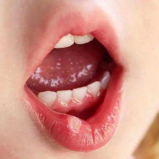 Стоматит - заболевание слизистой оболочки полости рта