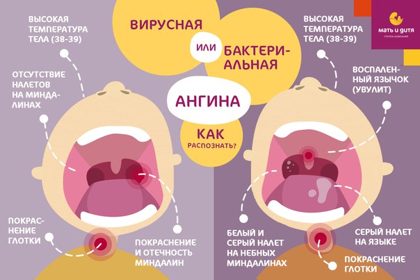 Ангина у ребенка: симптомы и лечение. советы педиатра