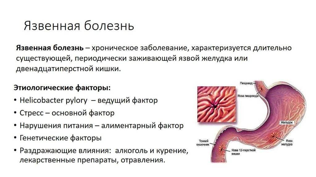 Язвенная болезнь желудка и 12-перстной кишки: лечение и диагностика симптомов, причин