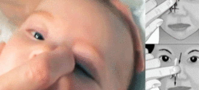 Дакриоцистит у новорожденных: лечение и симптомы, массаж и капли
