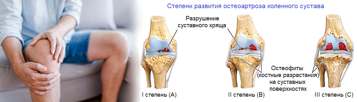 Хрящ коленного сустава артроз. Остеоартроз (деформирующий остеоартроз). Диагноз гонартроз 1 2 степени. Деформирующий остеоартроз клинические проявления.