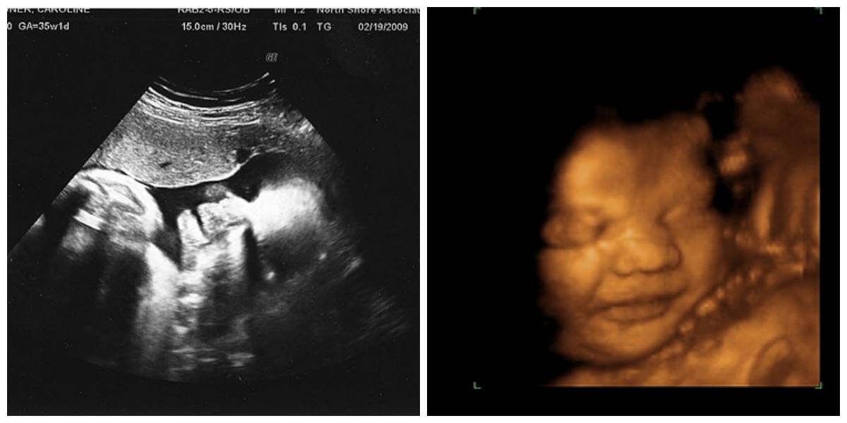 34 неделя беременности двойней | nestle baby