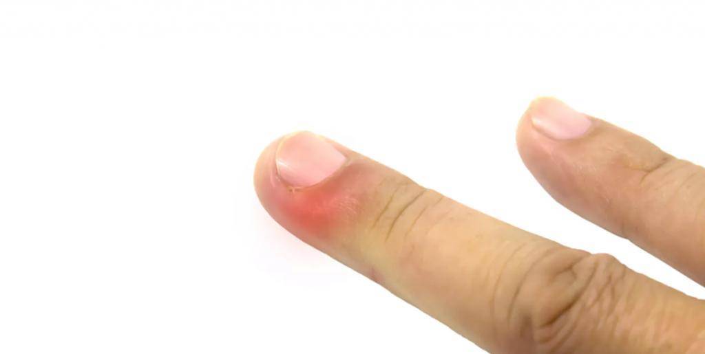 Нарыв на пальце руки возле ногтя лечение у ребенка - все о детях