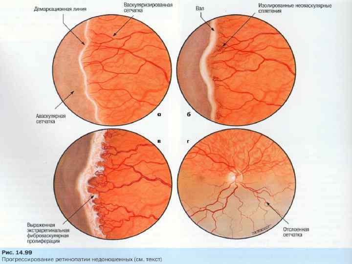 Фоновая ретинопатия: причины и лечение