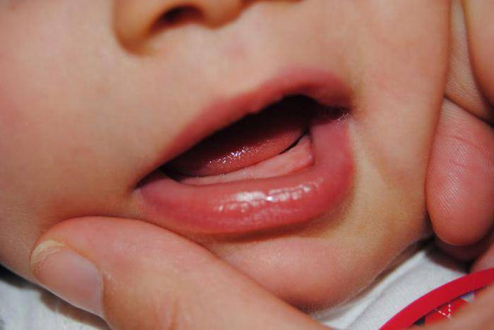 Прорезывание зубов у детей: фото десны у грудничков при воспалении и набухании