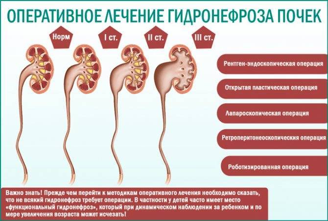 «поздний» гидронефроз. современные подходы к диагностике и лечению