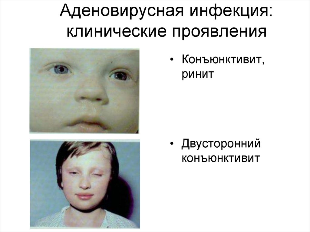 Как лечить аденовирусную инфекцию у детей: симптомы, лечение и антибиотики  - педиатрио