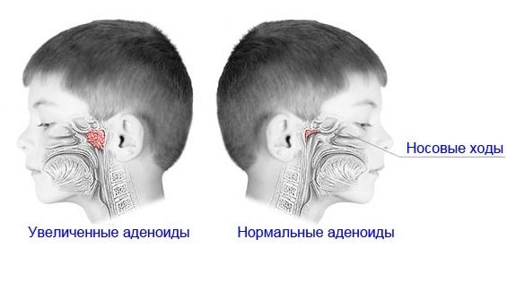 Аденоиды у детей