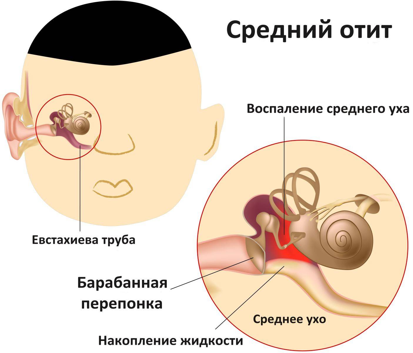 Отит у ребенка может стать следствием простудных заболеваний, а также являться причиной сбоя имунной системы.