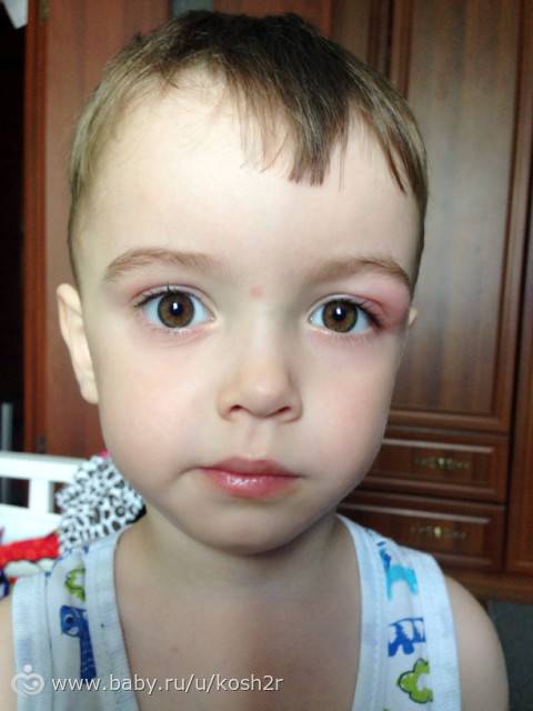Что делать, если ребенка укусил в глаз комар и все опухло