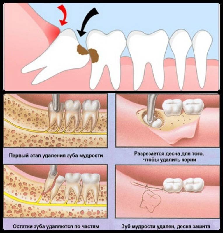 Сверхкомплектные зубы: причины возникновения, удаление, лечение