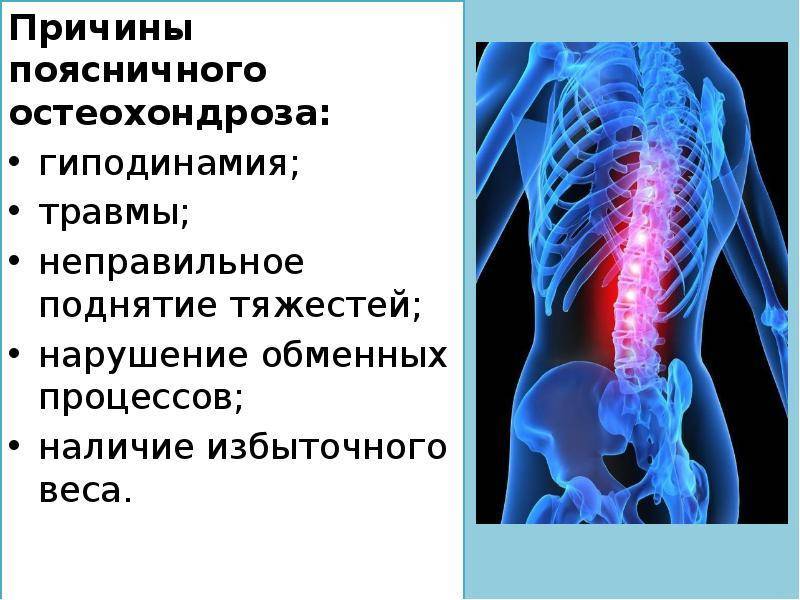 Синдромы остеохондроза поясничного отдела. Остеохондроз пояснично-крестцового отдела позвоночника. Остеохондроз причины возникновения. Клинические проявления поясничного остеохондроза.