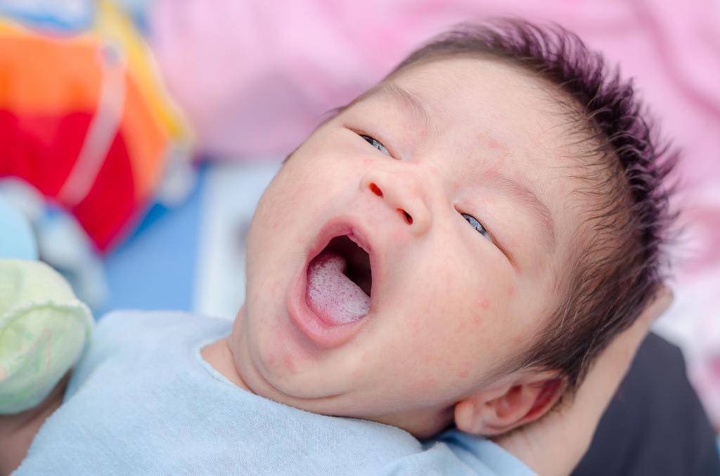 Молочница во рту у грудничка и новорожденного: причины и лечение, профилактика, мнение комаровского