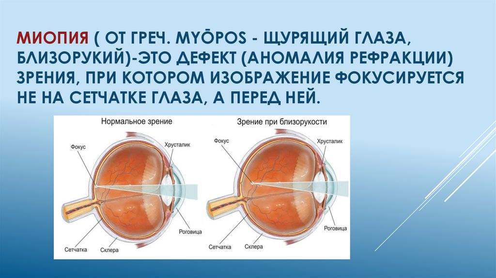 Что такое гиперметропия высокой, средней и слабой степени обоих глаз у детей?