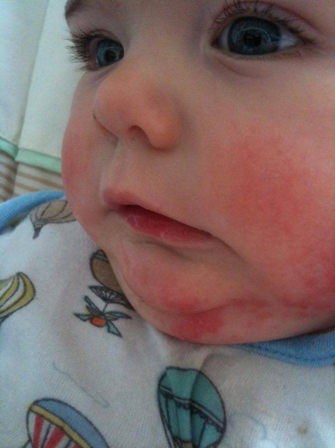 Кожная сыпь у детей: разбираем причины -  кожные высыпания у ребенка