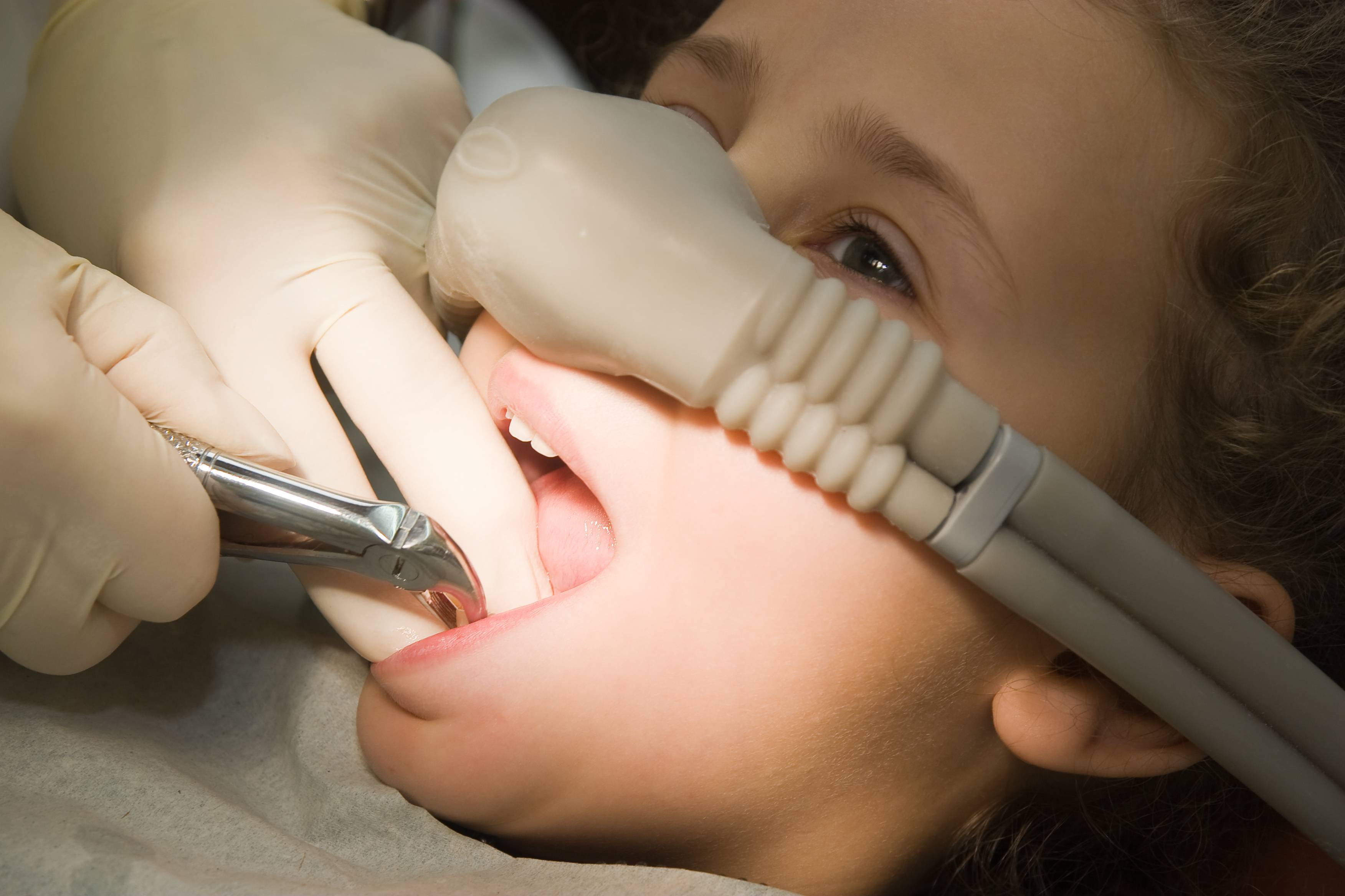 Можно приступать к удалению. Аппарат Матрикс седация. Седация в стоматологии для детей. Анестезия для детей в стоматологии. Седация закисью азота в детской стоматологии.