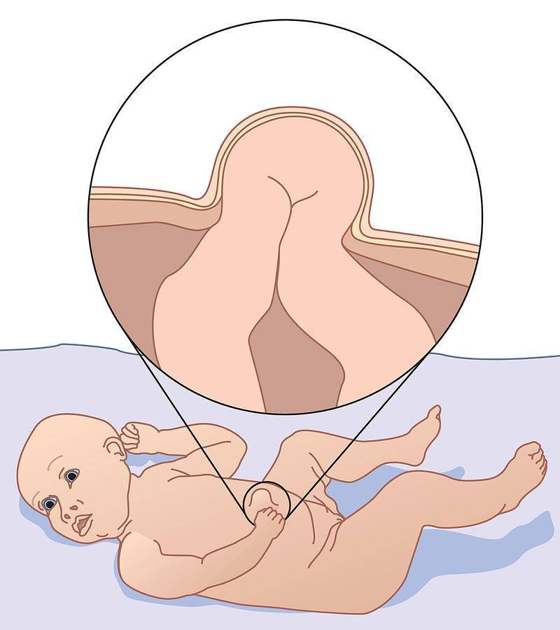 Кровит пупок у новорождённого: насколько это опасно, что это значит. что делать, если кровит пупок у новорождённого - автор екатерина данилова - журнал женское мнение