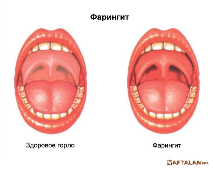 Какое красное горло у ребенка фото