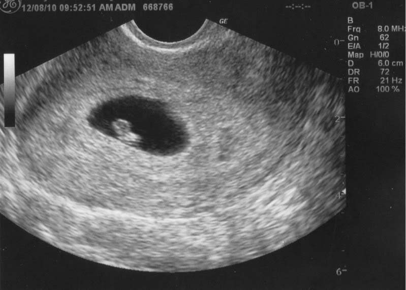 Что происходит с малышом и мамой на 4 неделе беременности от зачатия, каковы ощущения женщины, что покажет фото узи?