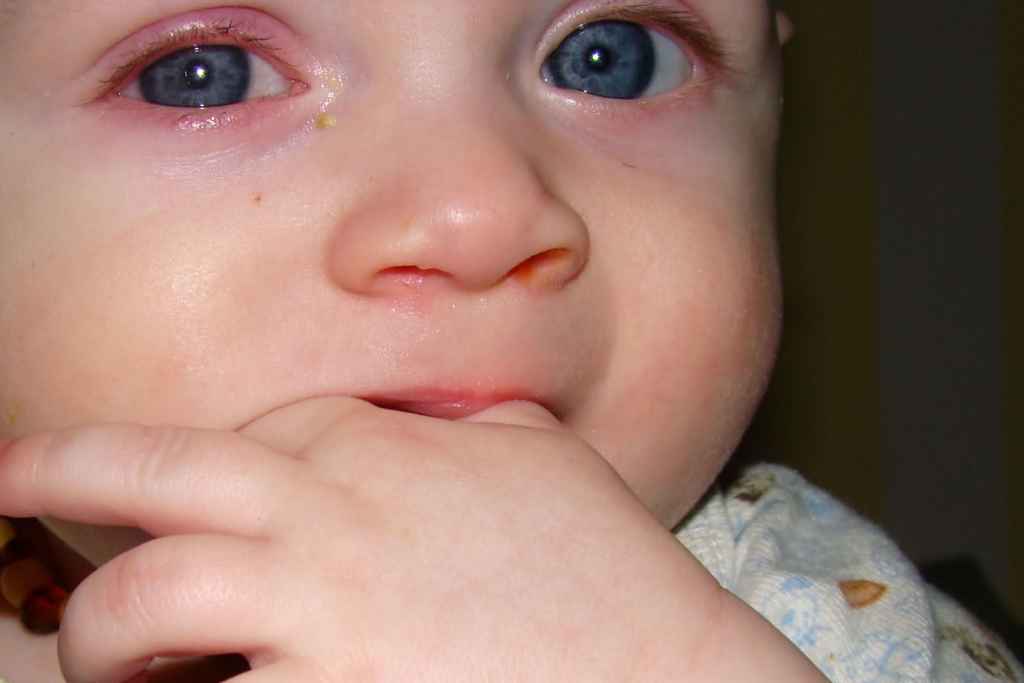 Аденовирусная инфекция у детей: симптомы, профилактика и методы лечения