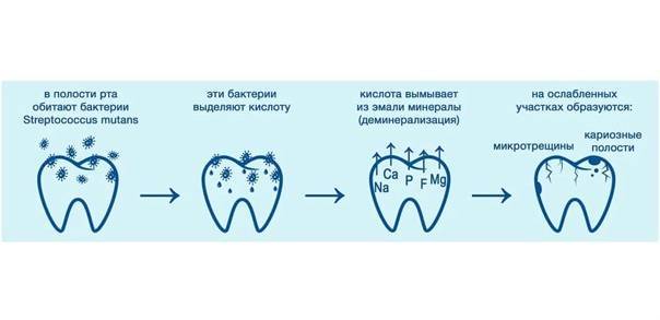 Кариес молочных зубов (причины, лечение, профилактика)