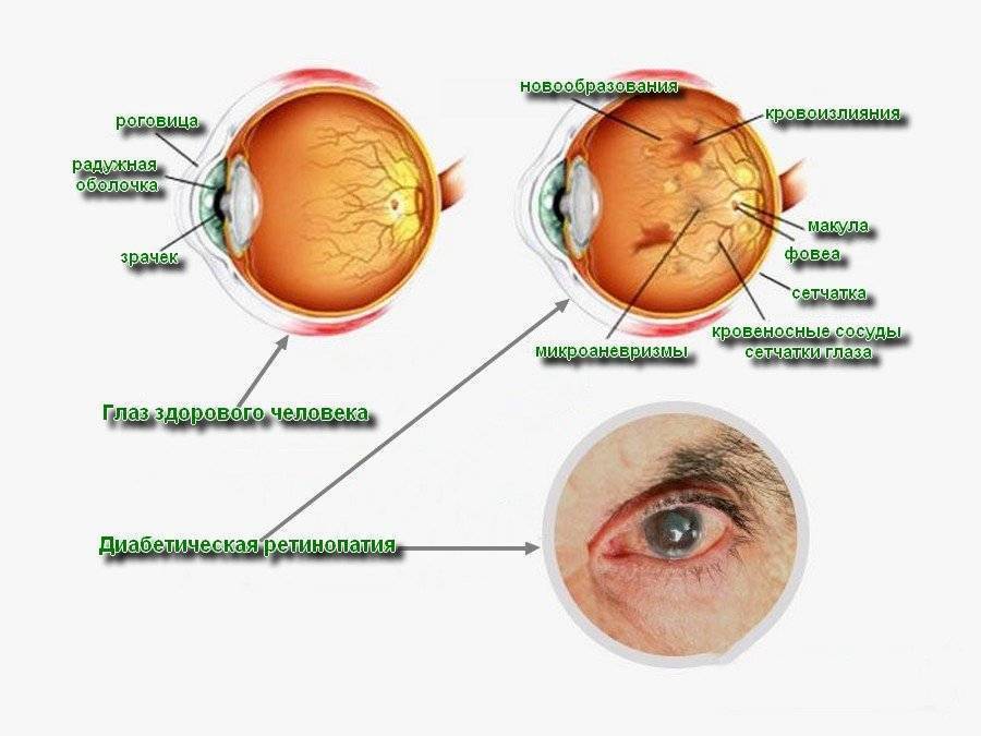 Ангиопатия сетчатки глаз