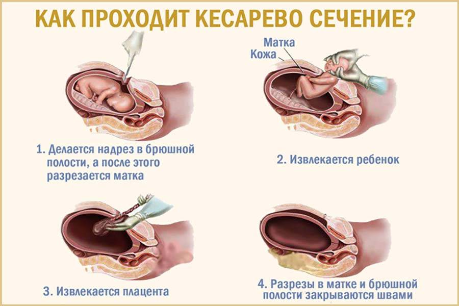 Кесарево сечение: разрез,швы, обработка, уход после операции