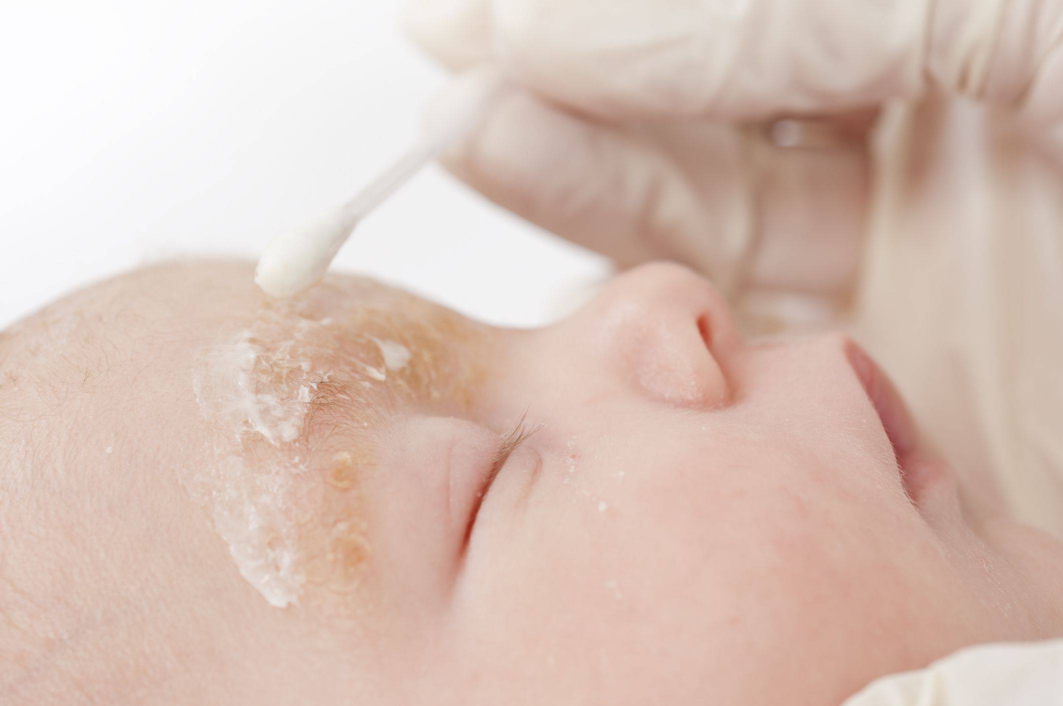 Почему у ребенка очень сухая кожа: причины и способы лечения