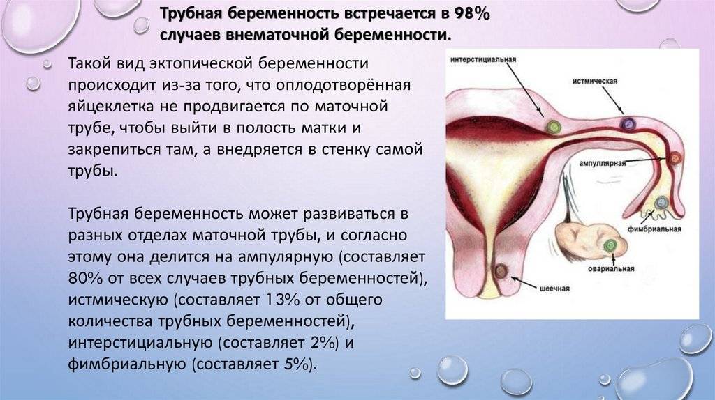 Внематочная беременность – симптомы, диагностика, факторы риска