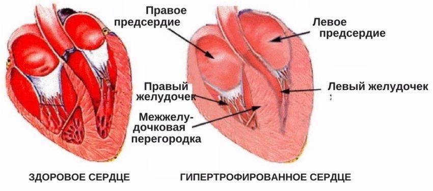 Дополнительная хорда в сердце у ребенка и взрослого: причины и лечение