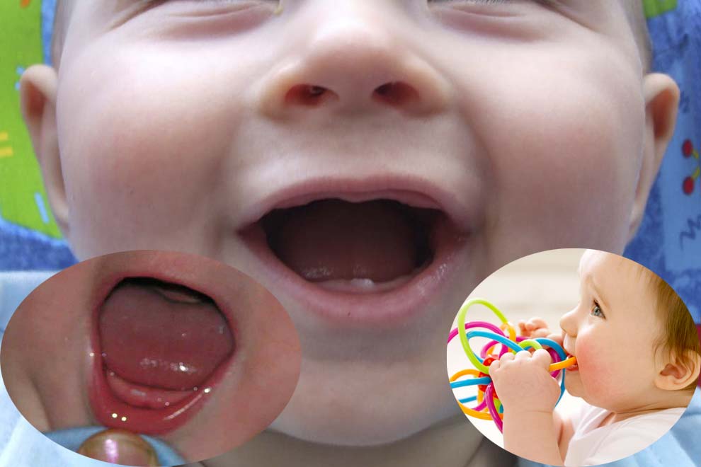 Прорезывание зубов в 2 месяца: норма или аномалия