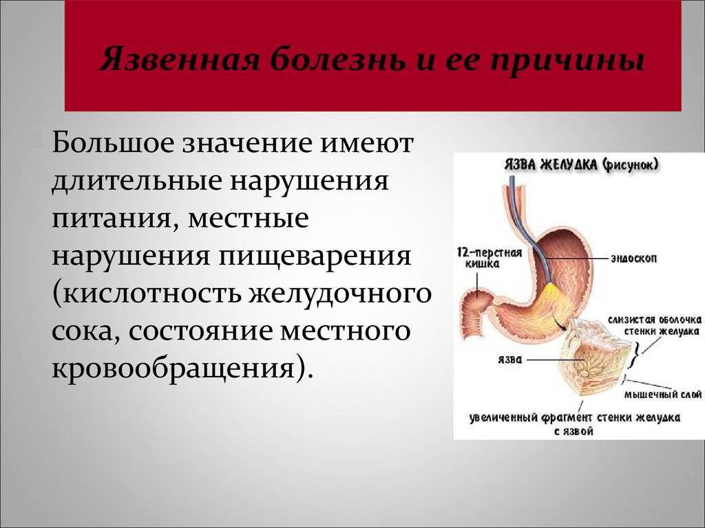 Почему в двенадцатиперстной кишке возникают язвы? как проявляются?