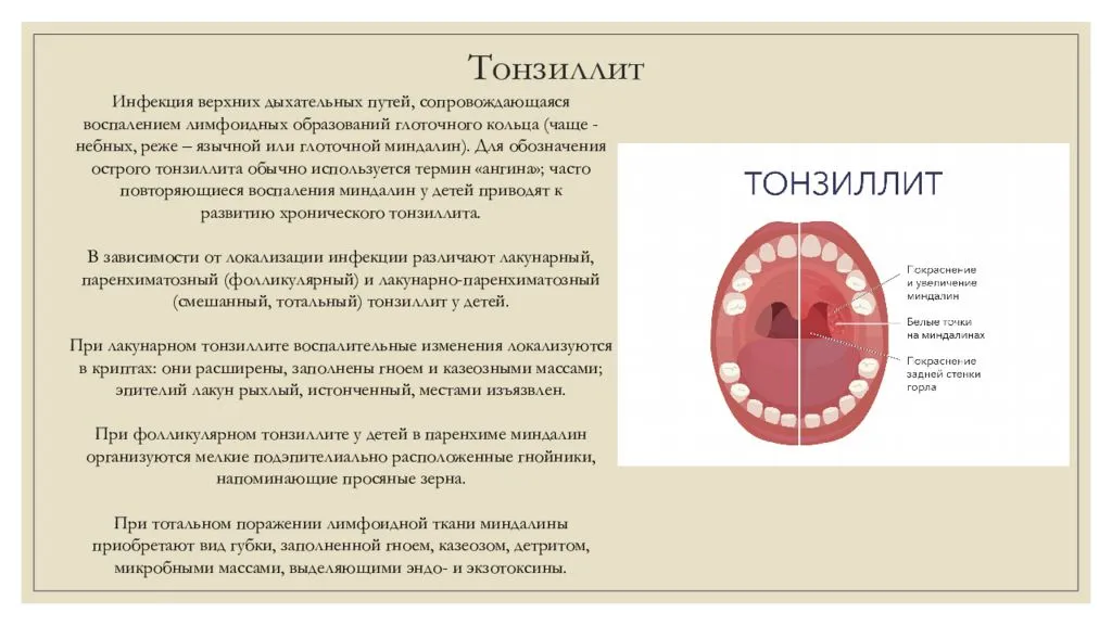 Особенности бактериальной ангины: симптомы, причины возникновения, лечение - лор клиника в чертаново
