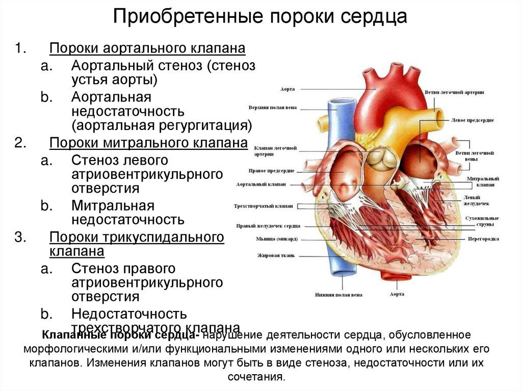Врожденные пороки сердца (впс) у детей
