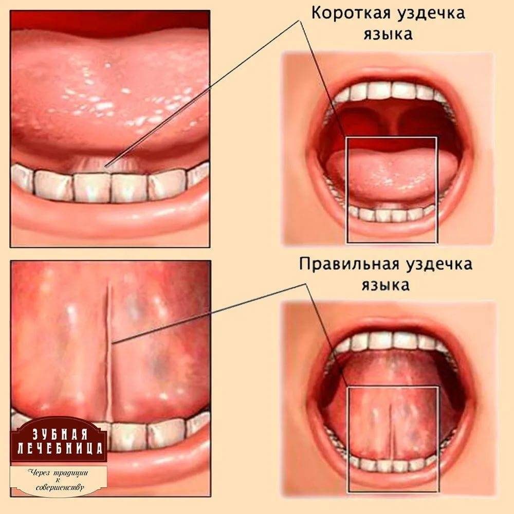 Подрезание уздечки под языком у детей: возраст, методы пластики, упражнения после операции
