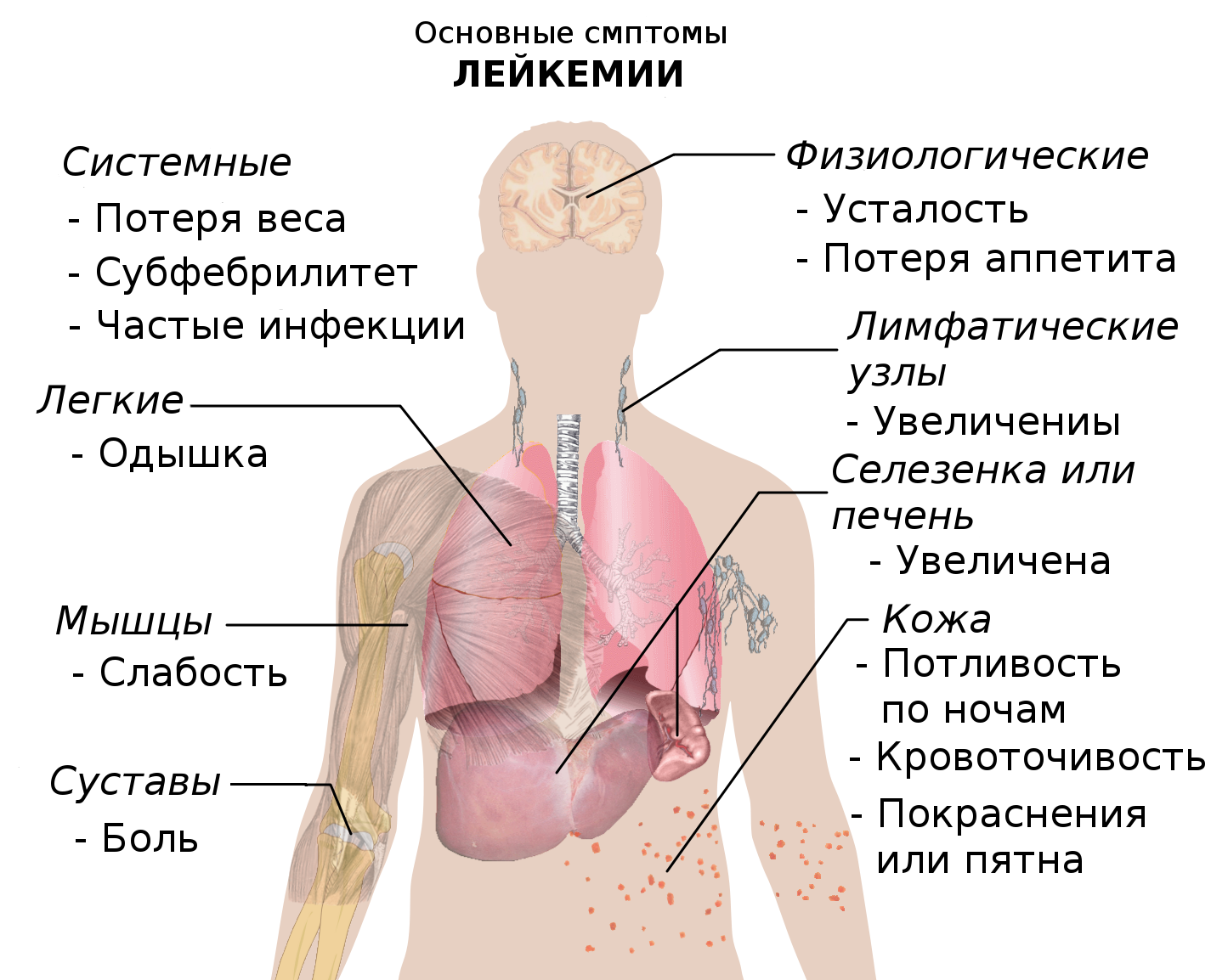 Лейкоз у мужчине