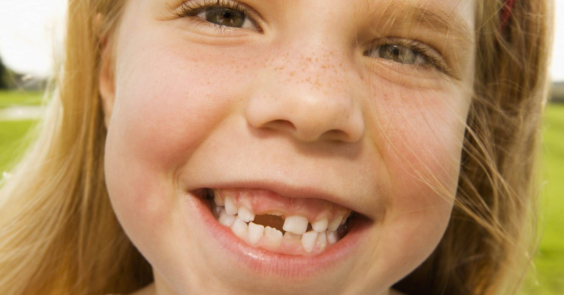 Почему растет второй. Кривые молочные зубы у ребенка. Кривые коренные зубы у детей. Кривые зубы у дите.