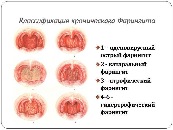 Фарингит – острый и хронический. симптомы и лечение фарингита.