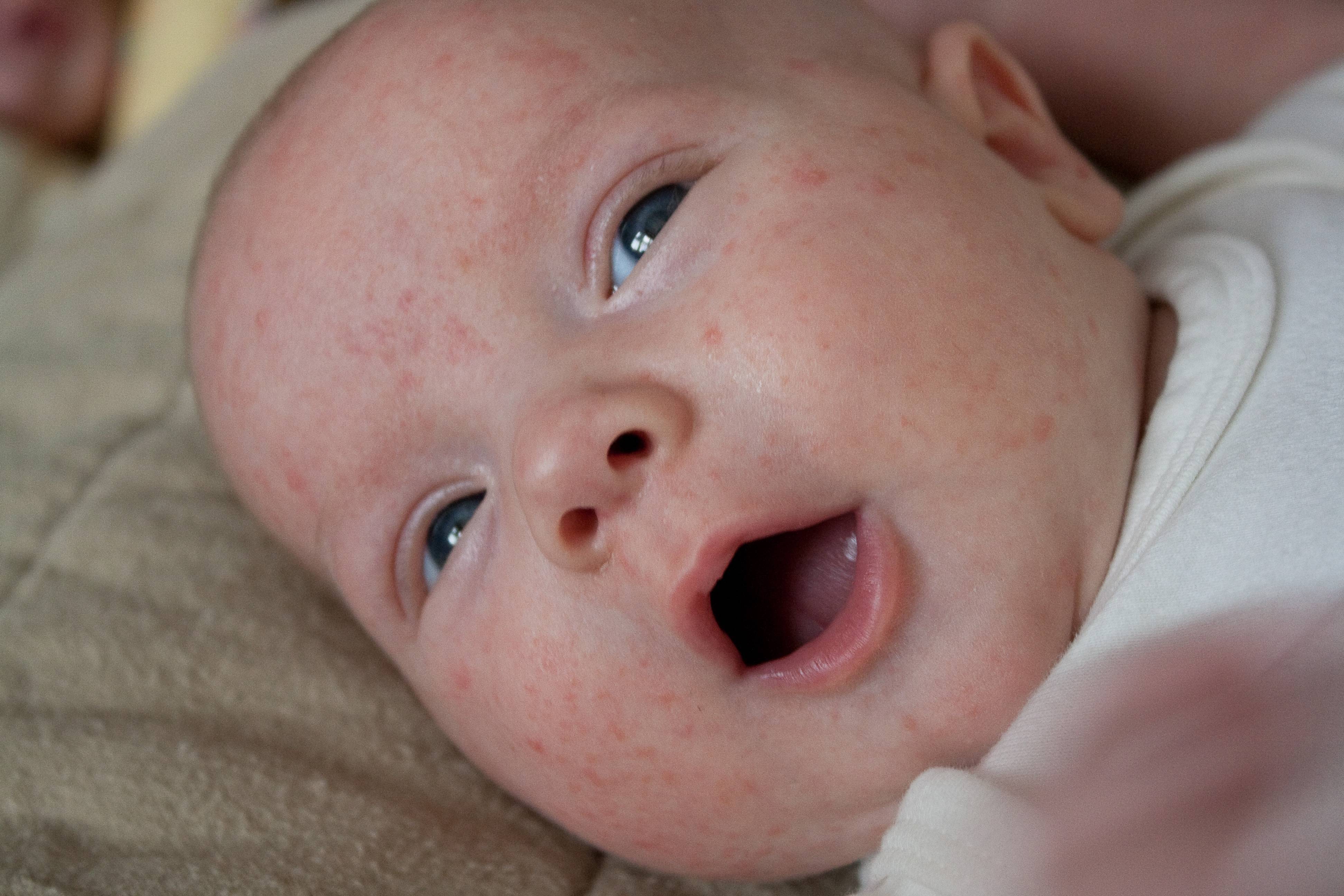 Прыщи у грудничков на лице: причины сыпи у новорожденных, лечение высыпаний у грудничков