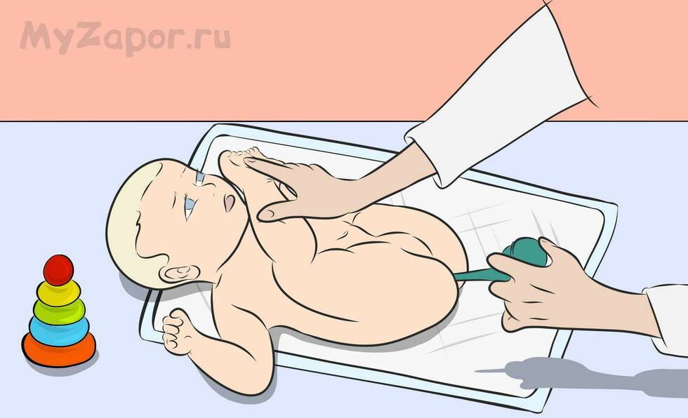 Запоры у новорожденных при искусственном вскармливании» | как помочь ребенку при запоре | микролакс®