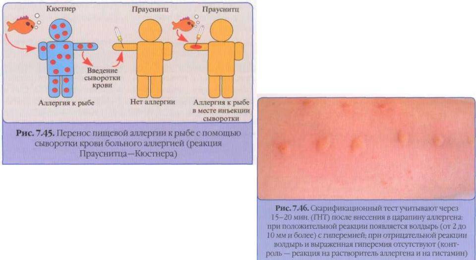 Аллергия виды с рисунками