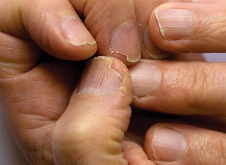 У ребенка слоятся ногти на ногах: причины и как их быстро вылечить