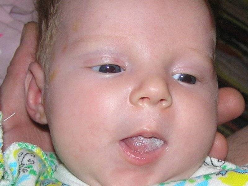 Детская стоматология kidsdental: налет на языке у ребенка – стоит ли беспокоиться?
