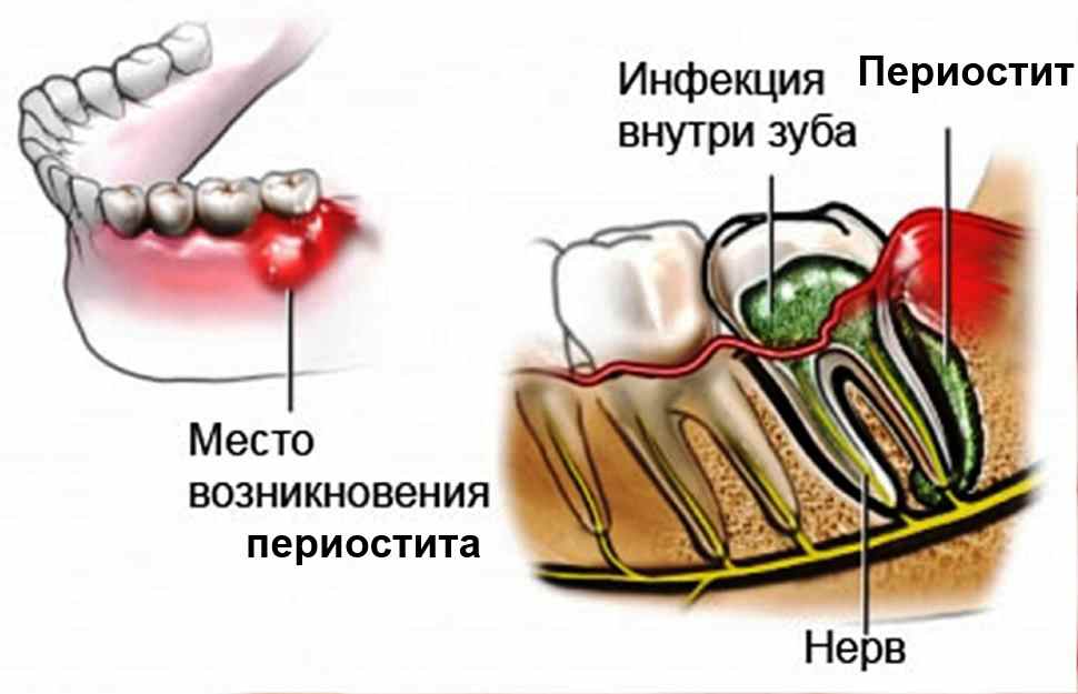 Синяк после обезболивания зуба: причины появления, чем опасен, как лечить