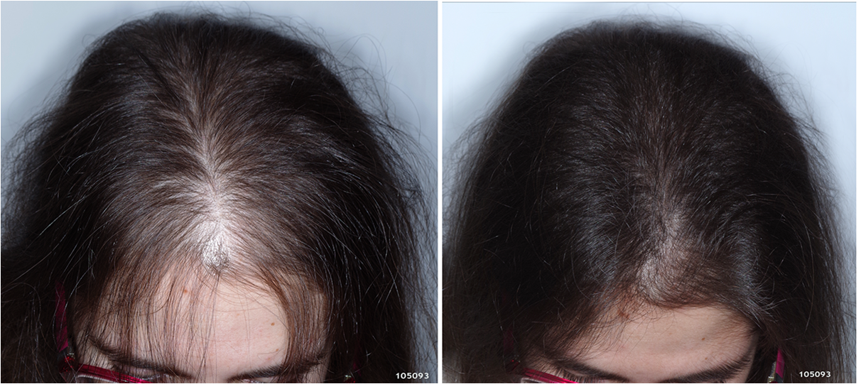 Выпадение волос во время и после беременности — норма ли это? • центр гинекологии в санкт-петербурге
