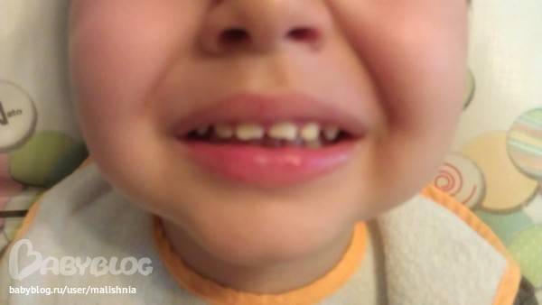 Травма молочного зуба: острая травма при ударе, травмы передних зубов у детей