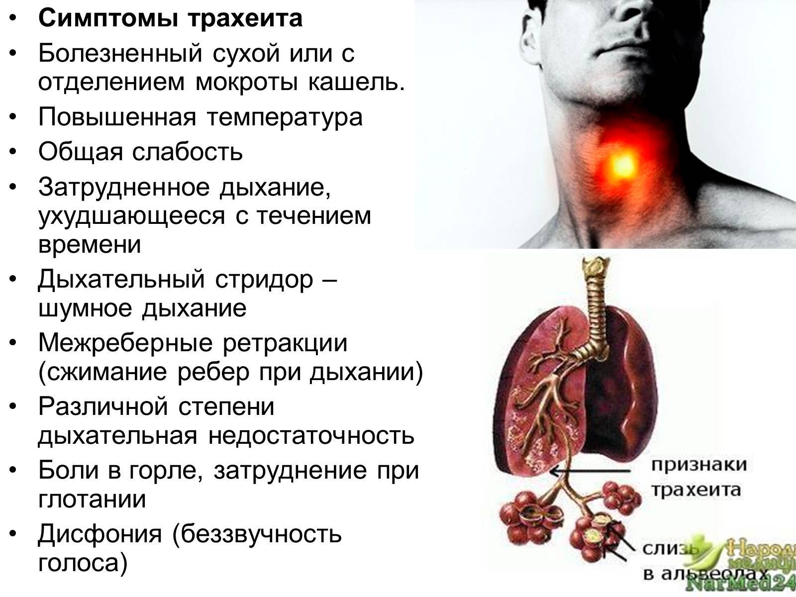 Трахеит у ребенка: симптомы и лечение / mama66.ru