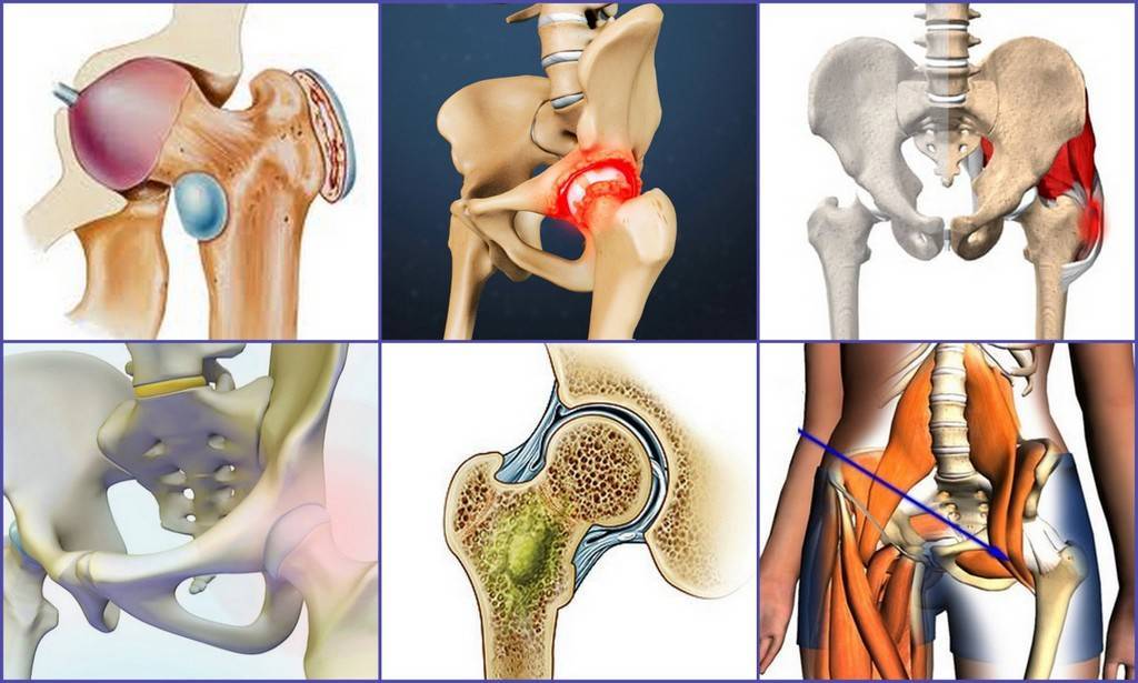 Посттравматический артрит сустава: симптомы, причины и лечение