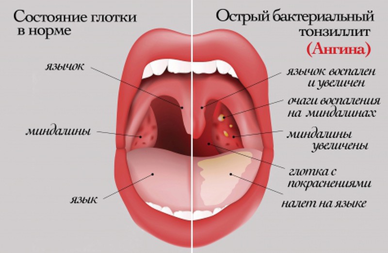 Тонзиллит у детей