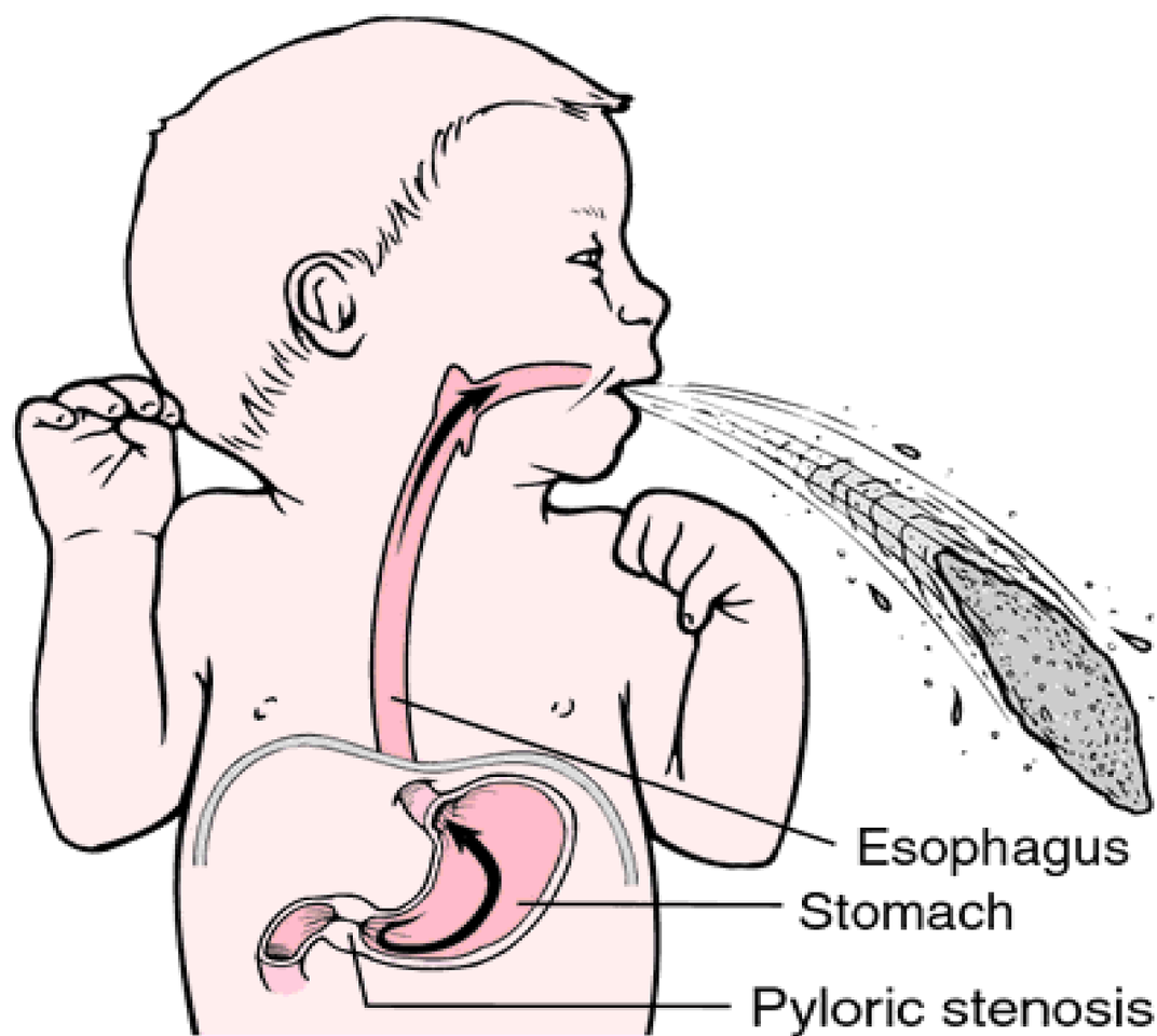 Пилороспазм и пилоростеноз у новорожденных и грудных детей: симптоматика, диагностика и лечение